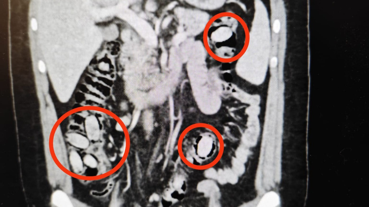 Midesinden çıkanlar şoke etti!