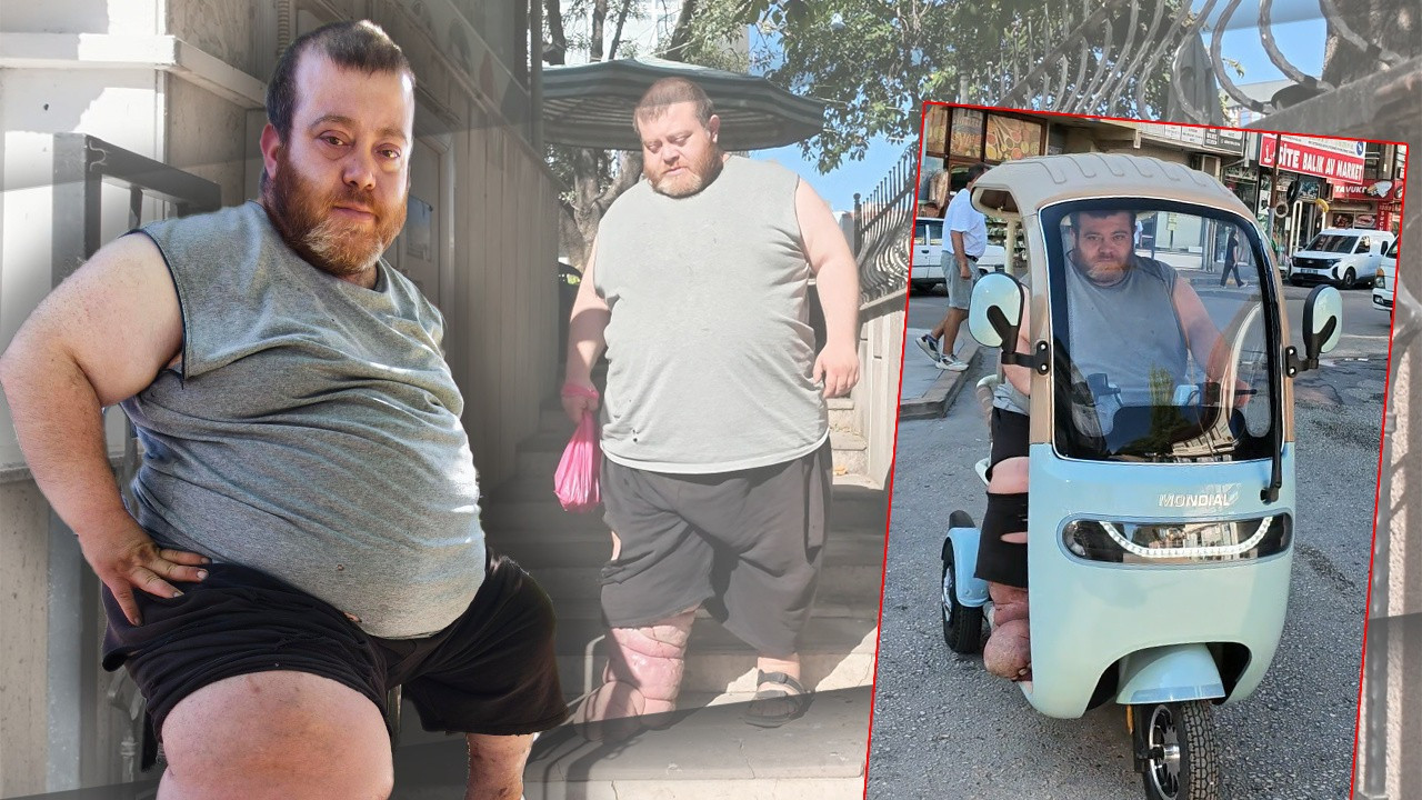 4 yıldır Fil hastalığıyla mücadele ediyor! Tek amacı yürüyebilmek ama 82 kilo vermesi gerekiyor