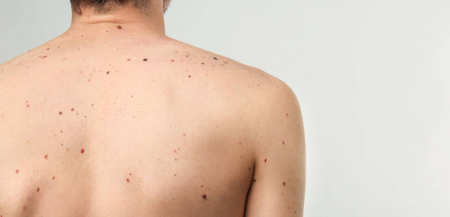 Sakın görmezden gelmeyin: Sandığınız kadar masum olmayabilir. Boyut, şekil ve renk değiştiren cilt lekelerine dikkat - Resim : 3