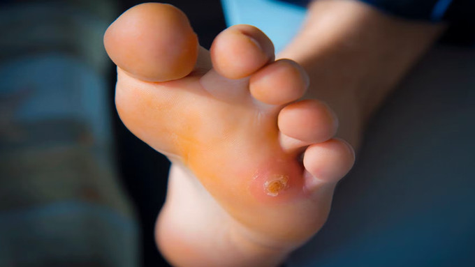 Ayak nasırını 1 günde geçirecek formül bulundu: Suyla karıştırıp sürmek yetiyormuş. Ayak nasırı evde nasıl geçer?